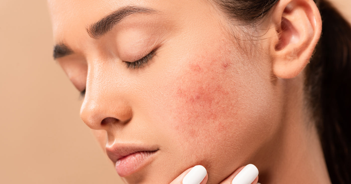 Les ingrédients naturels les plus efficaces contre l'acné