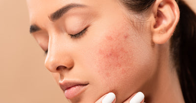 The most effective natural ingredients against acne