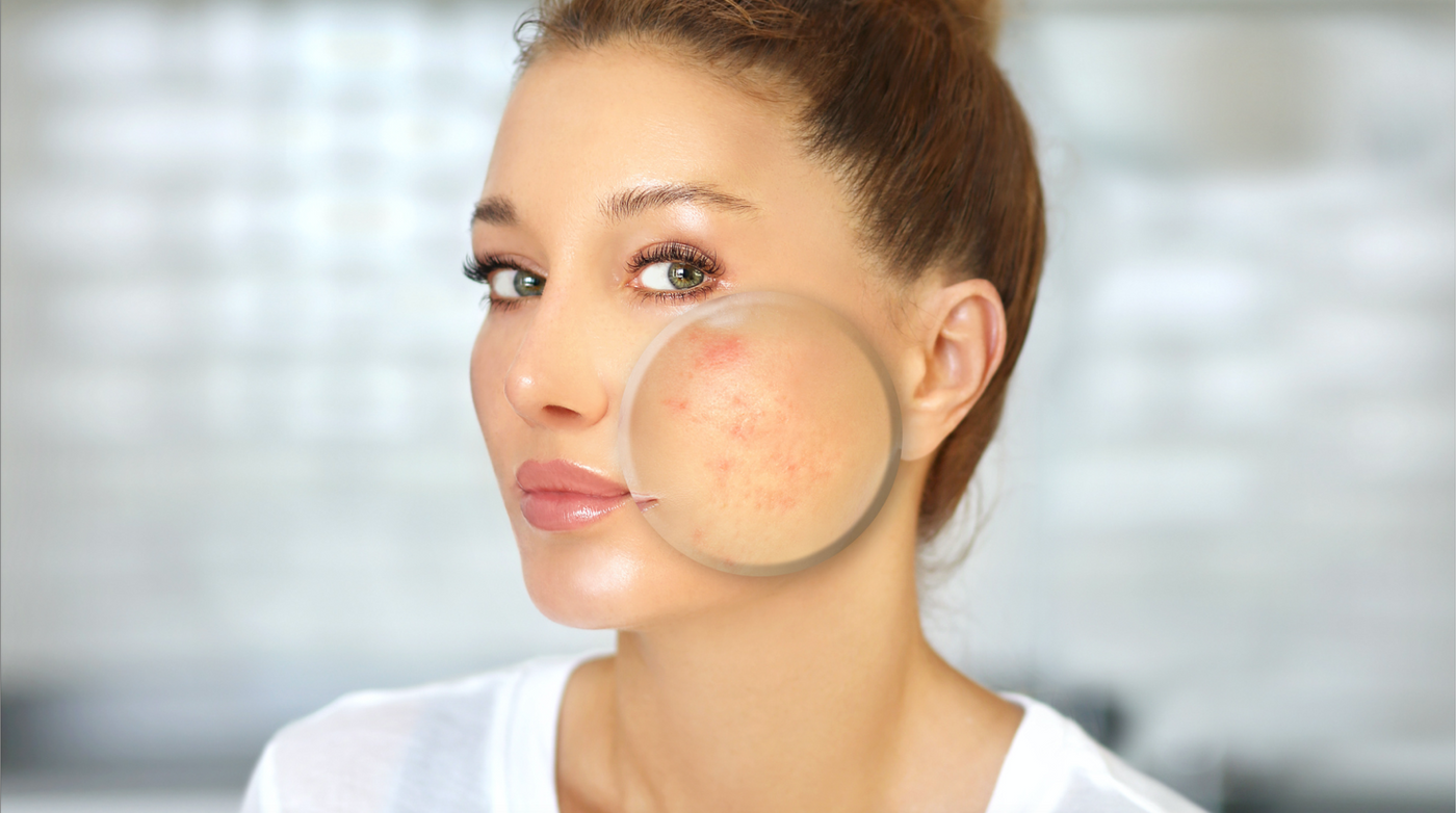 Top 5 des astuces pour faire disparaître les cicatrices d’acné
