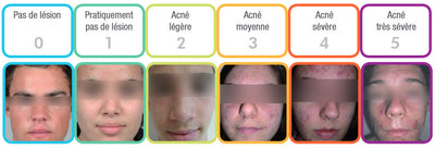 Acne: what are the causes?