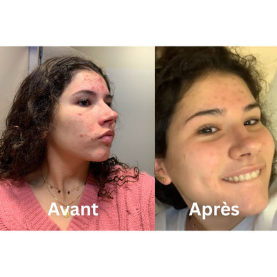 Routine anti-imperfections 1 mois